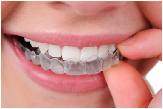 Clear Aligners in St Albans