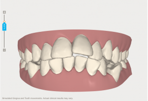 clincheck invisalign high oaks dental