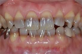 tetracycline staining