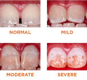 what_is_fluorosis