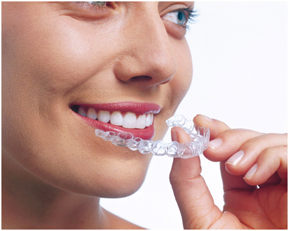 Invisalign Aligners