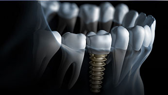 Dental Implants