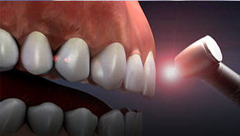 Laser Dentistry