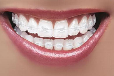 Clear Braces in St Albans  Fixed Braces Harpenden, Welwyn Garden City,  Hemel Hempstead