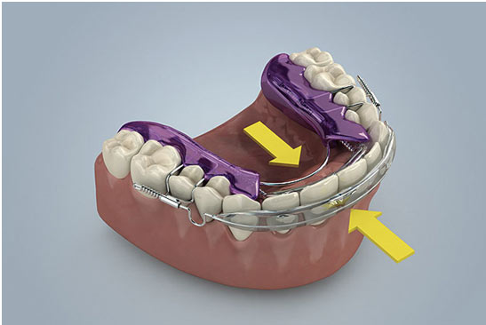 Inman Aligner in St Albans