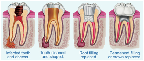 root canal