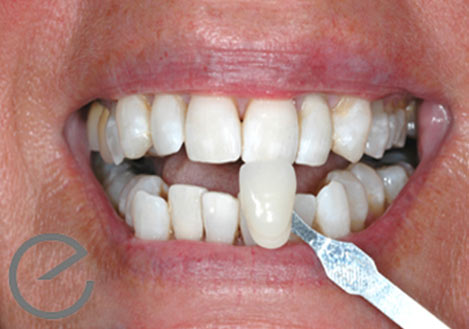 Enlighten Whitening Treatment - After