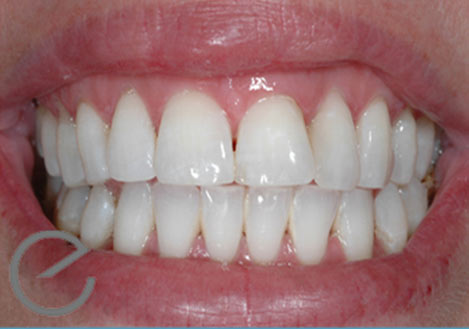 Enlighten’s Evolution Whitening - After