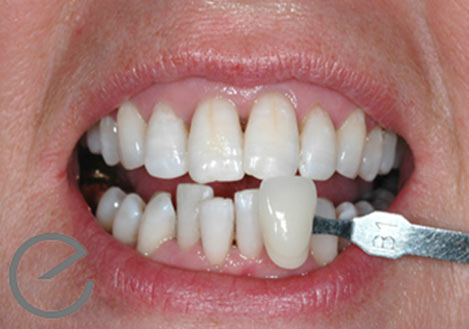Teeth Whitening using Evolution3 - After