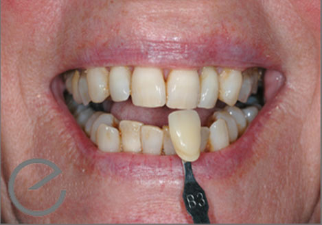 Evolution3 Whitening Treatment - Before