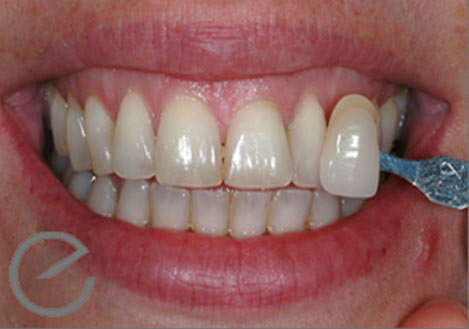 Enlighten’s Evolution Whitening - Before