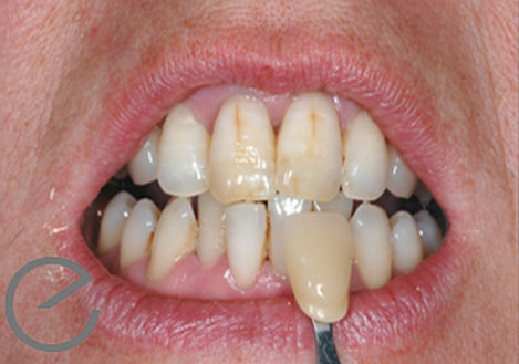 Teeth Whitening using Enlighten Evolution - Before