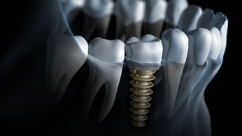 Dental Implants